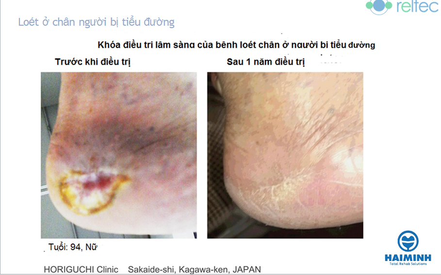 Điều trị lâm sàng loét chân ở bệnh nhân tiểu đường